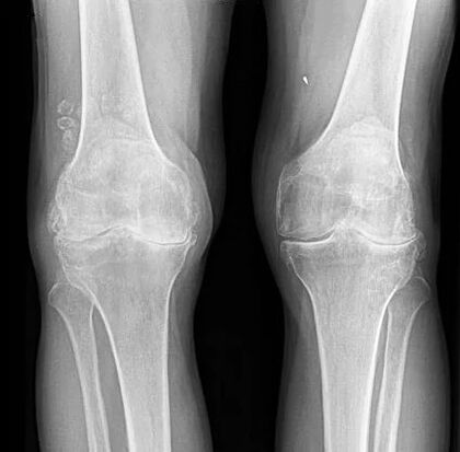 korai osteoarthritis a térd latin térdízület